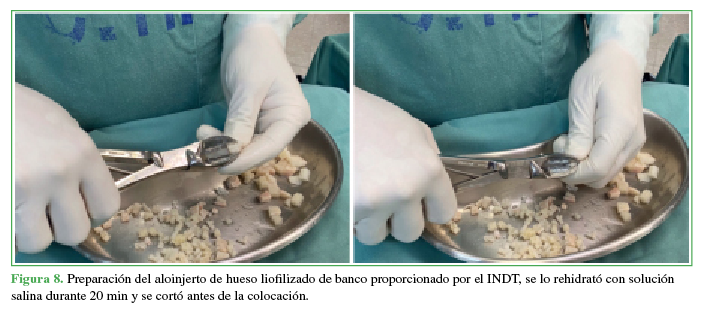 Preparación del aloinjerto de hueso liofilizado de banco
proporcionado por el INDT, se lo rehidrató con solución salina durante 20 min y
se cortó antes de la colocación.