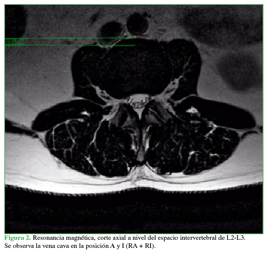 Resonancia magnética, corte axial a nivel del espacio
intervertebral de L2-L3. Se observa la vena cava en la posición
A y I (RA + RI).