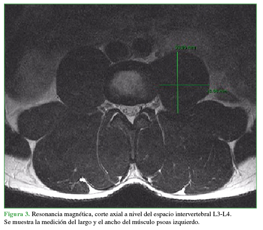  Resonancia magnética, corte axial a nivel del espacio
intervertebral L3-L4. Se muestra la medición del largo y el ancho del músculo psoas
izquierdo.