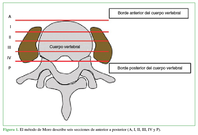 El método de Moro describe seis secciones de anterior a
posterior (A, I, II, III, IV y P).