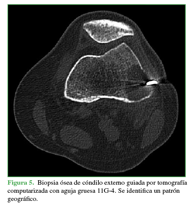 Biopsia ósea de cóndilo externo guiada por tomografía computarizada
con aguja gruesa 11G-4. Se identifica un patrón geográfico.