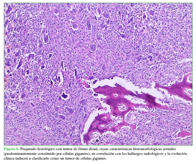  Preparado histológico con tumor de fémur distal, cuyas
características histomorfológicas actuales
(predominantemente constituido por células gigantes), en correlación con los
hallazgos radiológicos y la evolución clínica inducen a clasificarlo como un
tumor de células gigantes.
