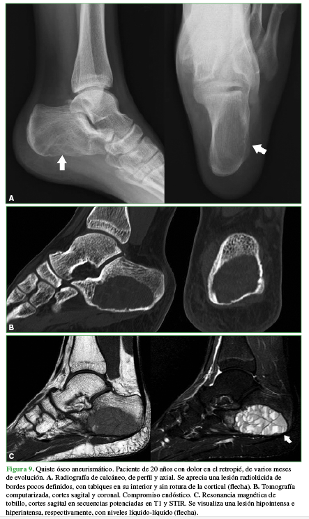 Quiste óseo aneurismático. Paciente de 20 años con dolor
en el retropié, de varios meses de evolución. A. Radiografía de calcáneo, de perfil y axial. Se aprecia una
lesión radiolúcida de bordes pocos definidos, con tabiques en su interior y sin
rotura de la cortical (flecha). B.
Tomografía computarizada, cortes sagital y coronal. Compromiso endóstico. C.
Resonancia magnética de tobillo, cortes sagital en
secuencias potenciadas en T1 y STIR. Se visualiza una lesión hipointensa e
hiperintensa, respectivamente, con niveles líquido-líquido (flecha)