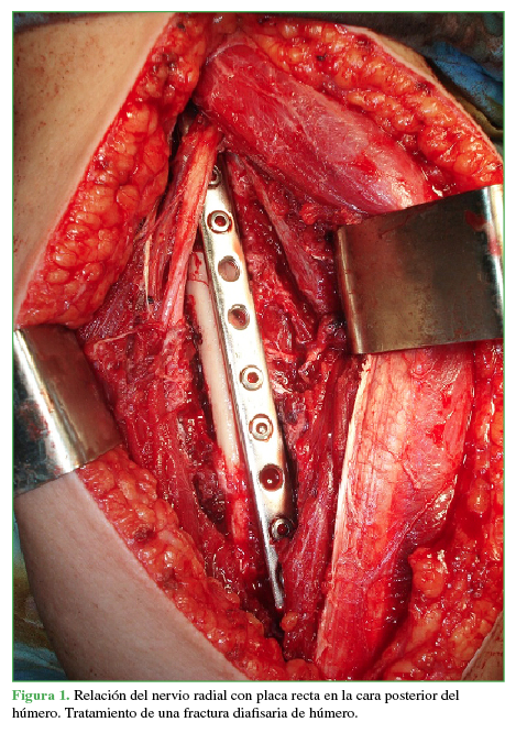 Relación del nervio radial con placa recta en la cara posterior del húmero Tratamiento de una fractura diafisaria de húmero.