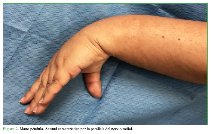 Mano péndula Actitud característica por la parálisis del nervio radial.