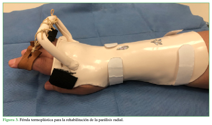 Férula termoplástica para la rehabilitación de la parálisis radial.