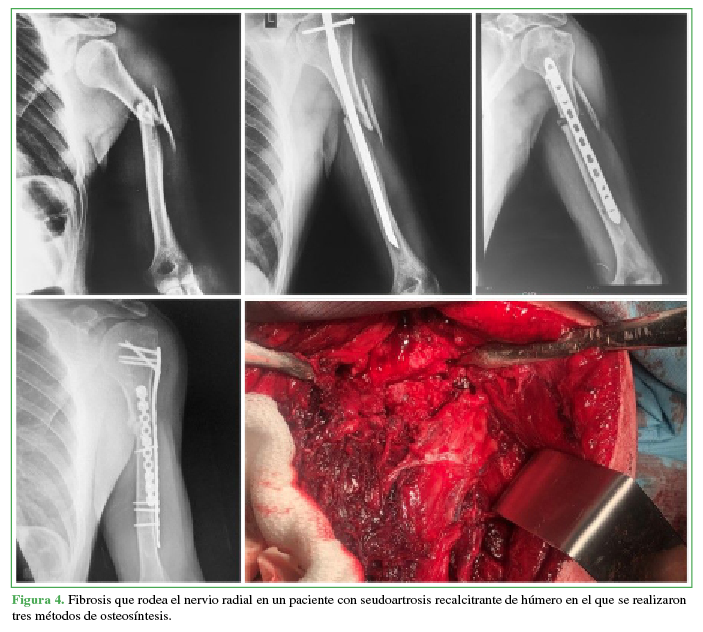 Fibrosis que rodea el nervio radial en un paciente con seudoartrosis recalcitrante de húmero en el que se
realizaron tres métodos de osteosíntesis.