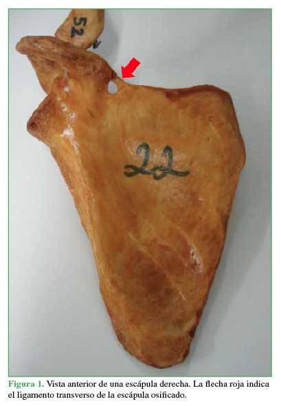 Vista anterior de una escápula derecha. La flecha roja indica el ligamento transverso de la escápula osificado.
