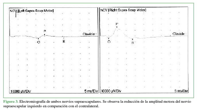 Electromiografía de ambos nervios supraescapulares. Se
observa la reducción de la amplitud motora del nervio supraescapular izquierdo
en comparación con el contralateral.