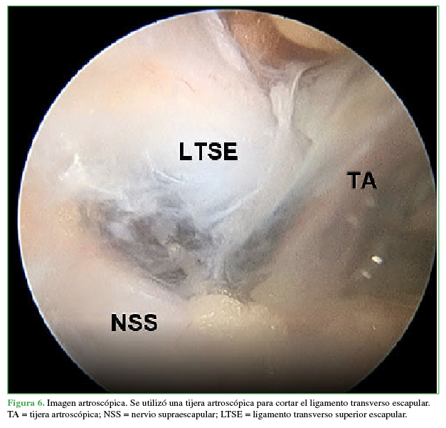 Imagen artroscópica. Se utilizó una tijera artroscópica para cortar el ligamento transverso escapular. TA = tijera artroscópica; NSS = nervio supraescapular, LTSE =  ligamento transverso superior escapular.