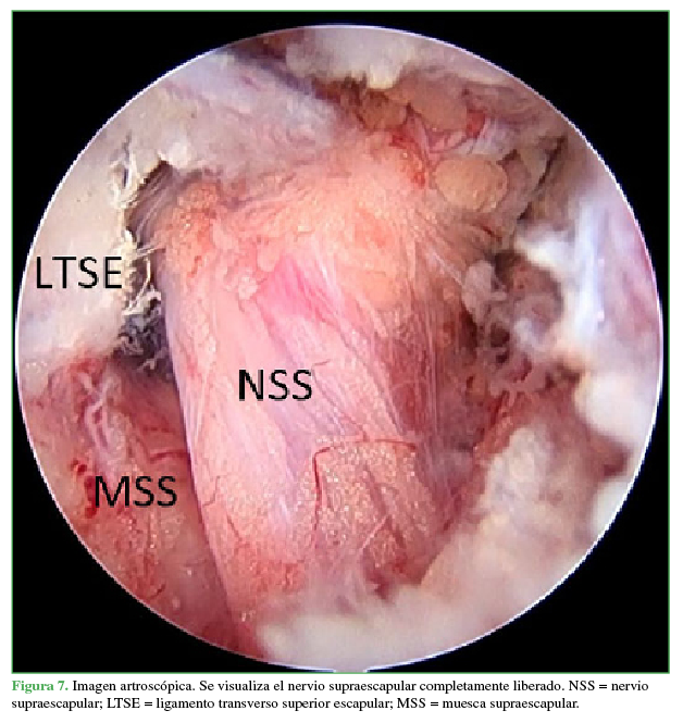 Imagen artroscópica. Se visualiza el nervio supraescapular completamente liberado. NSS = nervio supraescapular; LTSE = ligamento transverso superior escapular; MSS = muesca supraescapular.