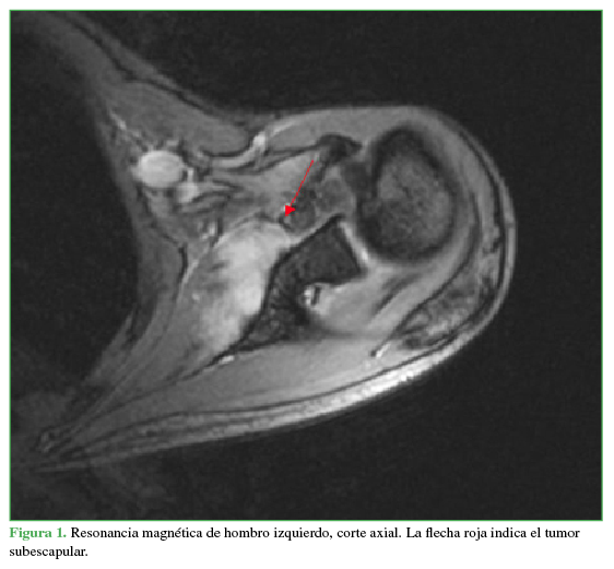 Resonancia magnética de hombro izquierdo, corte axial.
La flecha roja indica el tumor subescapular.