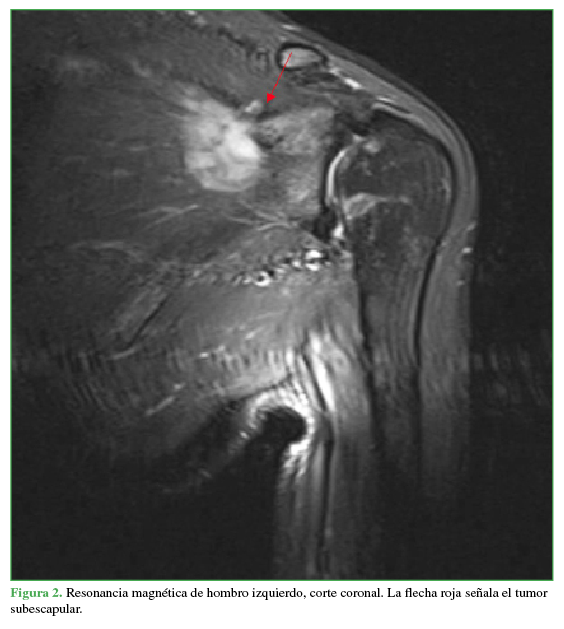 Resonancia magnética de hombro izquierdo, corte coronal.
La flecha roja señala el tumor subescapular.