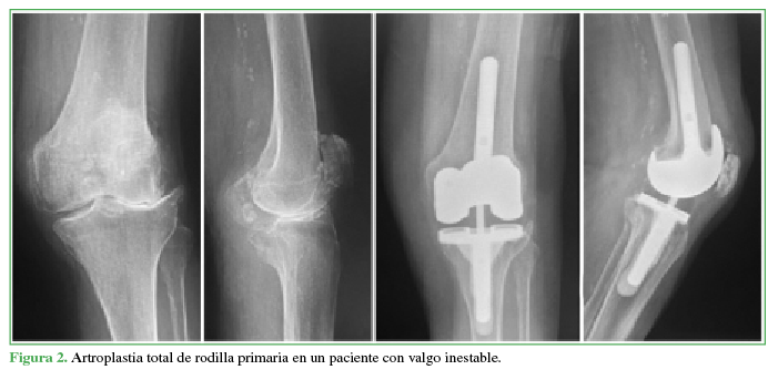 Artroplastia total de rodilla primaria en un paciente con valgo inestable