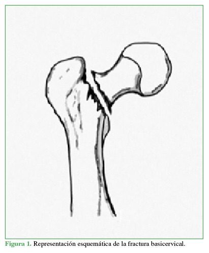 Representación esquemática de la fractura basicervical.