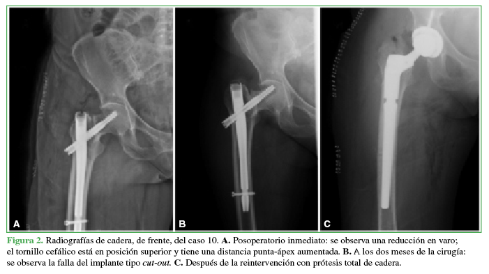 Radiografías de cadera, de frente, del caso 10. A. Posoperatorio inmediato: se observa una reducción en varo; el tornillo cefálico está en posición superior y tiene una distancia punta-ápex aumentada. B. A los dos meses de la cirugía: se observa la falla del impalnte tipo cut-out. C. Después de la reintervención con prótesis total de cadera. 