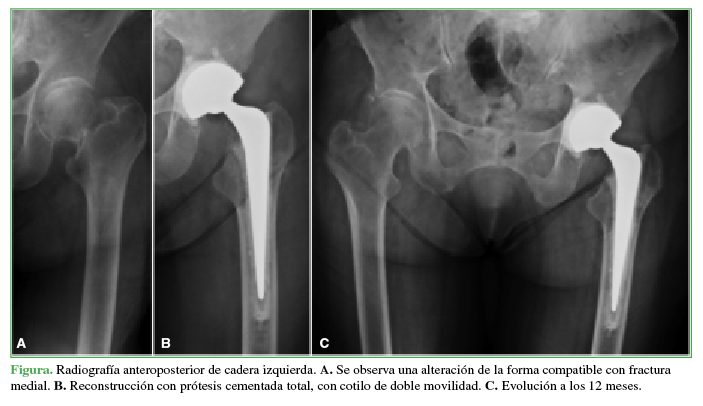 Radiografía anteroposterior de cadera
izquierda. A. Se observa una
alteración de la forma compatible con fractura medial. B. Reconstrucción con prótesis cementada total, con cotilo de doble movilidad. C. Evolución a los 12 meses