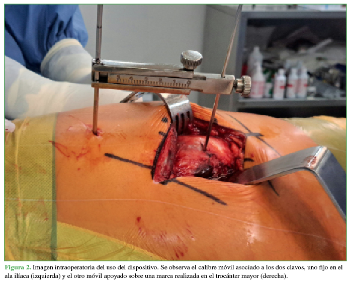 Imagen intraoperatoria
del uso del dispositivo. Se observa el calibre móvil asociado a los dos clavos,
uno fijo en el ala ilíaca (izquierda) y el otro móvil apoyado sobre una marca
realizada en el trocánter mayor (derecha).