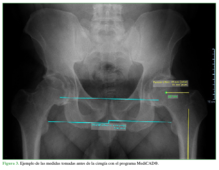 Ejemplo de las medidas tomadas antes
de la cirugía con el programa MediCAD®.