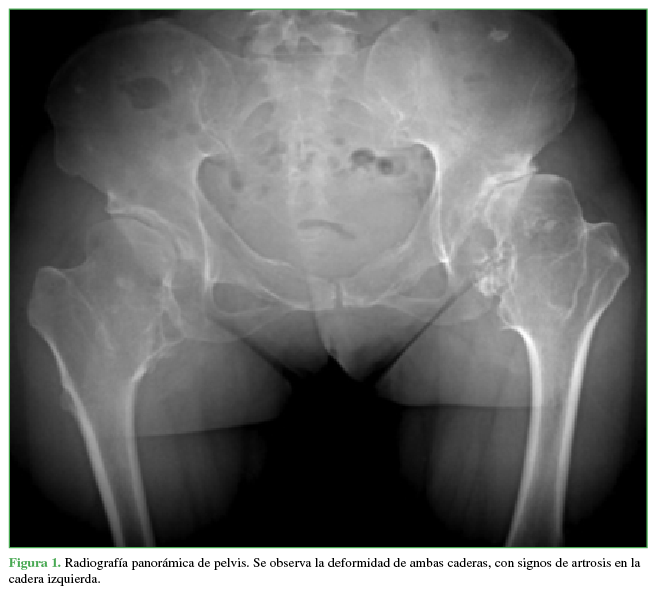 Radiografía panorámica de pelvis. Se
observa la deformidad de ambas caderas, con signos de artrosis en la cadera
izquierda.