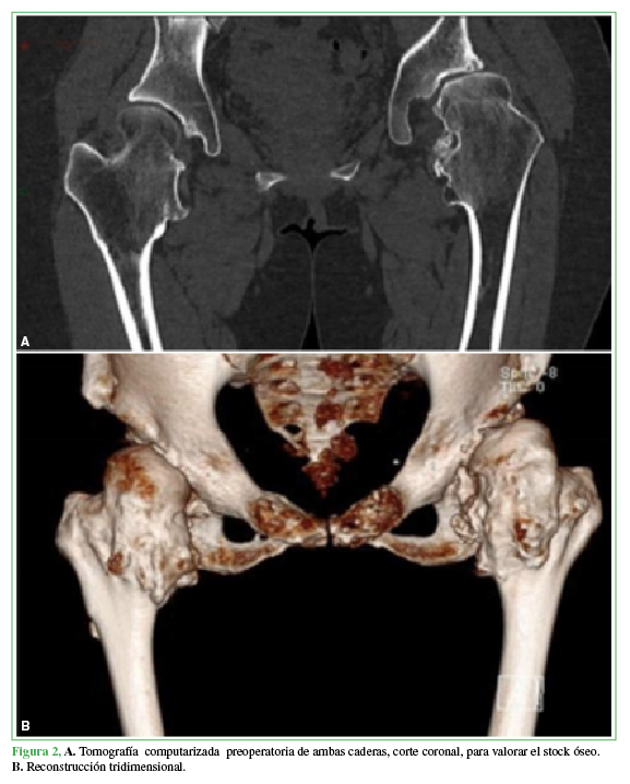 A. Tomografía computarizada preoperatoria de ambas caderas, corte
coronal, para valorar el stock óseo. B. Reconstrucción tridimensional.