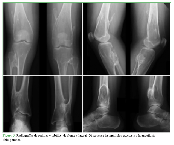 Radiografías de rodillas y tobillos,
de frente y lateral. Obsérvense las múltiples exostosis y la anquilosis tibio-peronea.