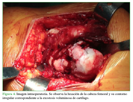 Imagen intraoperatoria.
Se observa la luxación de la cabeza femoral y su contorno irregular
correspondiente a la exostosis voluminosa de cartílago.
