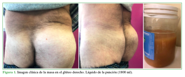 Imagen clínica de la masa en el glúteo
derecho. Líquido de la punción (1800 ml).