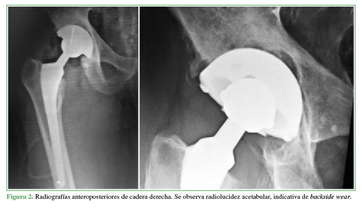 Radiografías anteroposteriores de
cadera derecha. Se observa radiolucidez acetabular,
indicativa de backside wear.
