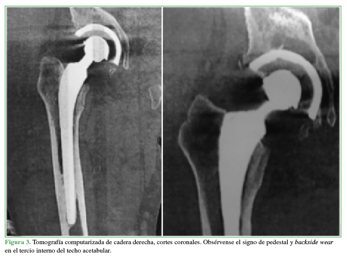 Tomografía computarizada de cadera
derecha, cortes coronales. Obsérvense el signo de pedestal y backside wear en el
tercio interno del techo acetabular.