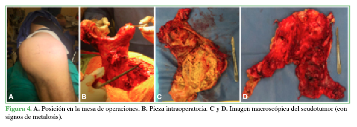 A. Posición en la mesa
de operaciones. B. Pieza
intraoperatoria. C y D. Imagen
macroscópica del seudotumor (con signos de metalosis).