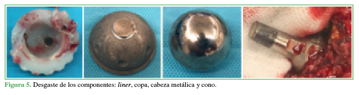 Desgaste de los componentes: liner, copa,
cabeza metálica y cono.