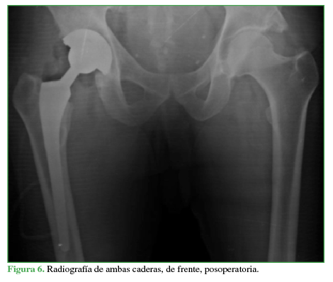 Radiografía de ambas caderas, de
frente, posoperatoria.