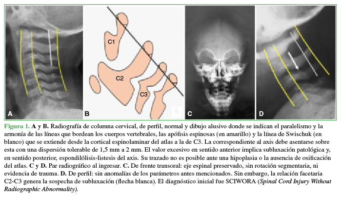 A y B. Radiograf&iacute;a de columna cervical, de perfil, normal y dibujo
alusivo donde se indican el paralelismo y la armon&iacute;a de las l&iacute;neas que bordean
los cuerpos vertebrales, las ap&oacute;fisis espinosas (en amarillo) y la l&iacute;nea de Swischuk (en blanco) que se extiende desde la cortical espinolaminar del atlas a la de C3. La correspondiente al
axis debe asentarse sobre esta con una dispersi&oacute;n tolerable de 1,5 mm a 2 mm. El valor excesivo en sentido anterior implica
subluxaci&oacute;n patol&oacute;gica y, en sentido posterior, espondil&oacute;lisis-listesis del axis. Su trazado no es posible ante una
hipoplasia o la ausencia de osificaci&oacute;n del atlas. C y D. Par radiogr&aacute;fico al ingresar. C. De frente transoral: eje espinal
preservado, sin rotaci&oacute;n segmentaria, ni evidencia de trauma. D. De perfil: sin anomal&iacute;as de los
par&aacute;metros antes mencionados. Sin embargo, la relaci&oacute;n facetaria
C2-C3 genera la sospecha de subluxaci&oacute;n (flecha blanca). El diagn&oacute;stico inicial fue SCIWORA (Spinal
Cord Injury Without Radiographic Abnormality)