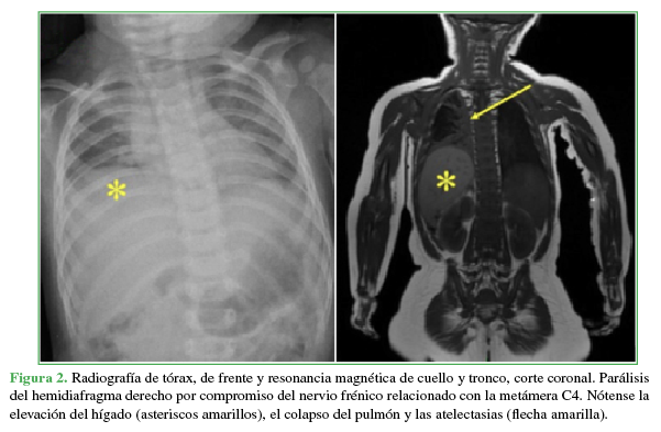 Radiograf&iacute;a de t&oacute;rax, de frente y
resonancia magn&eacute;tica de cuello y tronco, corte coronal. Par&aacute;lisis del hemidiafragma derecho por compromiso del nervio fr&eacute;nico
relacionado con la met&aacute;mera C4. N&oacute;tense la elevaci&oacute;n
del h&iacute;gado (asteriscos amarillos), el colapso del pulm&oacute;n y las atelectasias
(flecha amarilla).