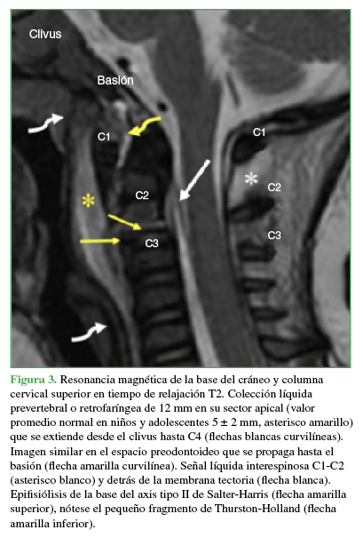 Resonancia magn&eacute;tica de la base del
cr&aacute;neo y columna cervical superior en tiempo de relajaci&oacute;n T2. Colecci&oacute;n
l&iacute;quida prevertebral o retrofar&iacute;ngea
de 12 mm en su sector apical (valor promedio normal en ni&ntilde;os y adolescentes 5 &plusmn;
2 mm, asterisco amarillo) que se extiende desde el clivus
hasta C4 (flechas blancas curvil&iacute;neas). Imagen similar en el espacio preodontoideo que se propaga hasta el basi&oacute;n
(flecha amarilla curvil&iacute;nea). Se&ntilde;al l&iacute;quida interespinosa
C1-C2 (asterisco blanco) y detr&aacute;s de la membrana tectoria
(flecha blanca). Epifisi&oacute;lisis de la base del axis
tipo II de Salter-Harris (flecha amarilla superior),
n&oacute;tese el peque&ntilde;o fragmento de Thurston-Holland
(flecha amarilla inferior).