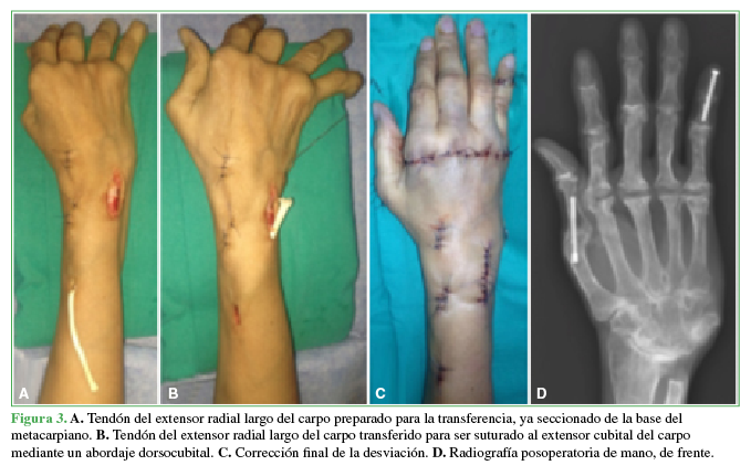 A. Tendón del extensor radial largo del carpo preparado para la
transferencia, ya seccionado de la base del metacarpiano. B. Tendón del extensor radial largo del carpo transferido para ser
suturado al extensor cubital del carpo mediante un abordaje dorsocubital.
C. Corrección final de la
desviación. D. Radiografía
posoperatoria de mano, de frente.