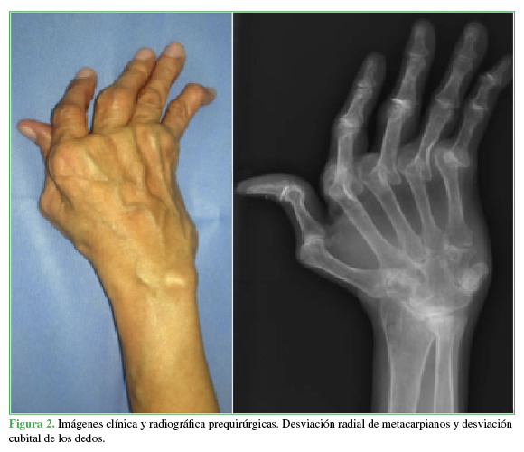 Imágenes clínica y radiográfica prequirúrgicas. Desviación radial de metacarpianos y
desviación cubital de los dedos.