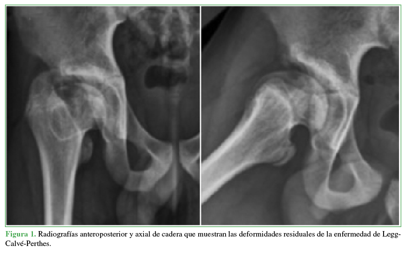 Radiografías anteroposterior y axial
de cadera que muestran las deformidades residuales de la enfermedad de
Legg-Calvé-Perthes.