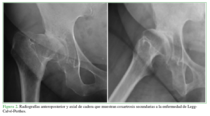 Radiografías anteroposterior y axial
de cadera que muestran coxartrosis secundarias a la enfermedad de Legg-Calvé-Perthes.