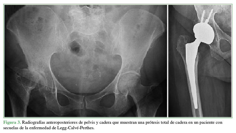 Radiografías anteroposteriores de
pelvis y cadera que muestran una prótesis total de cadera en un paciente con
secuelas de la enfermedad de Legg-Calvé-Perthes.