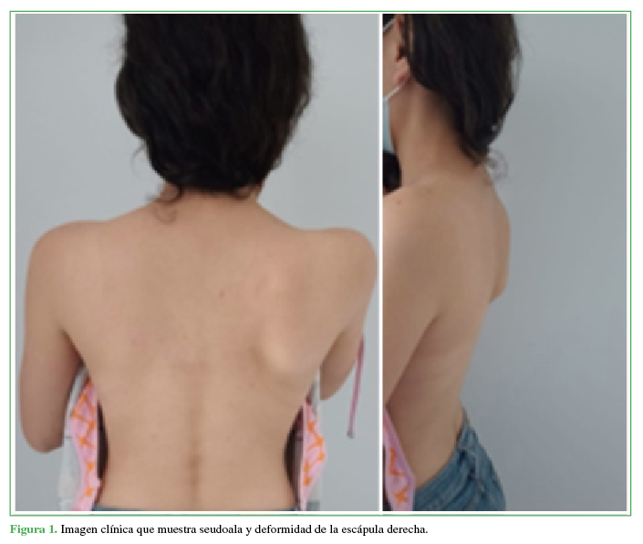 Imagen clínica que muestra seudoala y deformidad de la escápula derecha