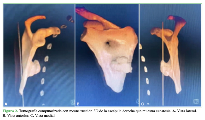 Tomografía computarizada con
reconstrucción 3D de la escápula derecha que muestra exostosis. A. Vista lateral. B. Vista anterior. C. Vista medial. 

 