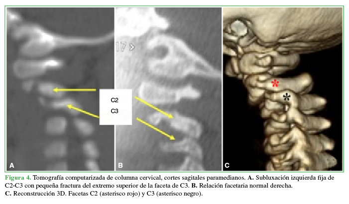 Tomograf&iacute;a
computarizada de columna cervical, cortes sagitales paramedianos.
A. Subluxaci&oacute;n izquierda fija de C2-C3 con
peque&ntilde;a fractura del extremo superior de la faceta de C3. B. Relaci&oacute;n facetaria normal derecha. 

 

C. Reconstrucci&oacute;n 3D. Facetas C2 (asterisco rojo) y
C3 (asterisco negro).