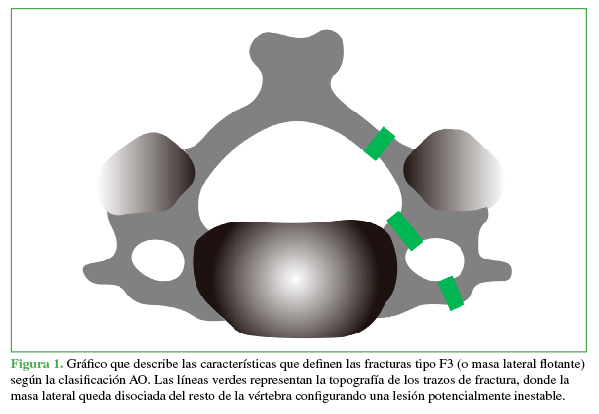 Gráfico que describe las
características que definen las fracturas tipo F3 (o masa lateral flotante)
según la clasificación AO. Las líneas verdes representan la topografía de los
trazos de fractura, donde la masa lateral queda disociada del resto de la vértebra
configurando una lesión potencialmente inestable.
