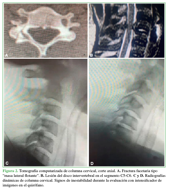 Tomografía computarizada de columna
cervical, corte axial. A. Fractura
facetaria tipo “masa lateral flotante”. B.
Lesión del disco intervertebral en el segmento C5-C6. C y D. Radiografías dinámicas de columna cervical. Signos de
inestabilidad durante la evaluación con intensificador de imágenes en el
quirófano.