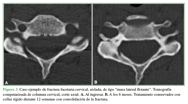 Caso ejemplo de fractura facetaria
cervical, aislada, de tipo “masa lateral flotante”. Tomografía computarizada de
columna cervical, corte axial. A. Al
ingresar. B. A los 6 meses.
Tratamiento conservador con collar rígido durante 12 semanas con consolidación
de la fractura.