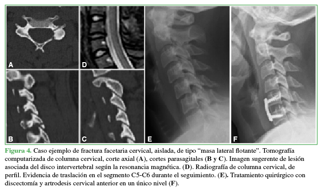  Caso ejemplo de fractura facetaria
cervical, aislada, de tipo “masa lateral flotante”. Tomografía computarizada de
columna cervical, corte axial (A),
cortes parasagitales (B y C). Imagen
sugerente de lesión asociada del disco intervertebral según la resonancia
magnética (D). Radiografía de
columna cervical, de perfil. Evidencia de traslación en el segmento C5-C6
durante el seguimiento (E).
Tratamiento quirúrgico con discectomía y artrodesis
cervical anterior en un único nivel (F).
