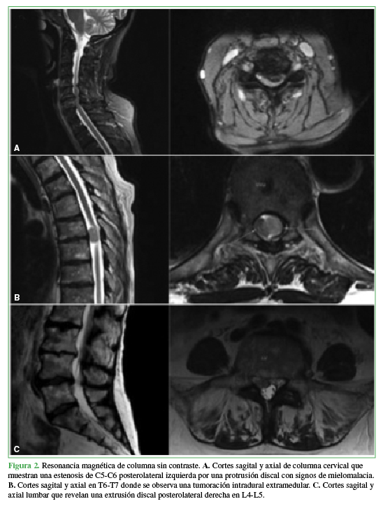Resonancia magn&eacute;tica de columna sin
contraste. A. Cortes sagital y axial
de columna cervical que muestran una estenosis de C5-C6 posterolateral
izquierda por una protrusi&oacute;n discal con signos de mielomalacia. B. Cortes sagital y axial en T6-T7
donde se observa una tumoraci&oacute;n intradural extramedular. C. Cortes sagital y axial lumbar que revelan una extrusi&oacute;n discal
posterolateral derecha en L4-L5.