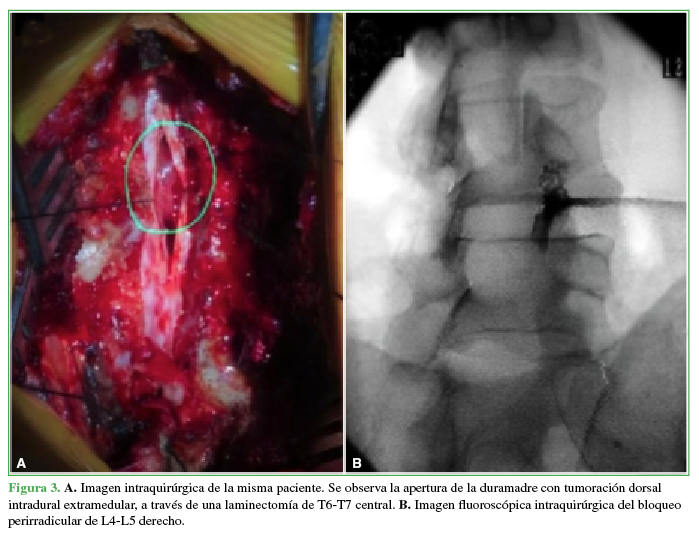  A. Imagen intraquir&uacute;rgica de la misma paciente. Se observa la
apertura de la duramadre con tumoraci&oacute;n dorsal intradural extramedular, a
trav&eacute;s de una laminectom&iacute;a de T6-T7 central. B. Imagen fluorosc&oacute;pica intraquir&uacute;rgica
del bloqueo perirradicular de L4-L5 derecho.